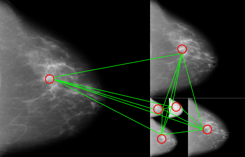 Artificial Intelligence Can See Breast Cancer Before it Happens