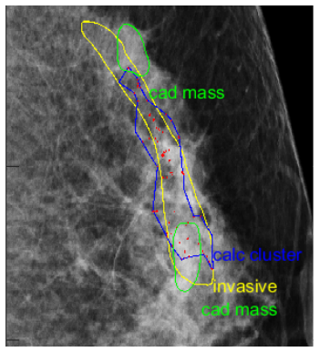 computer-aided detection (CAD) delineates invasive brest cancer