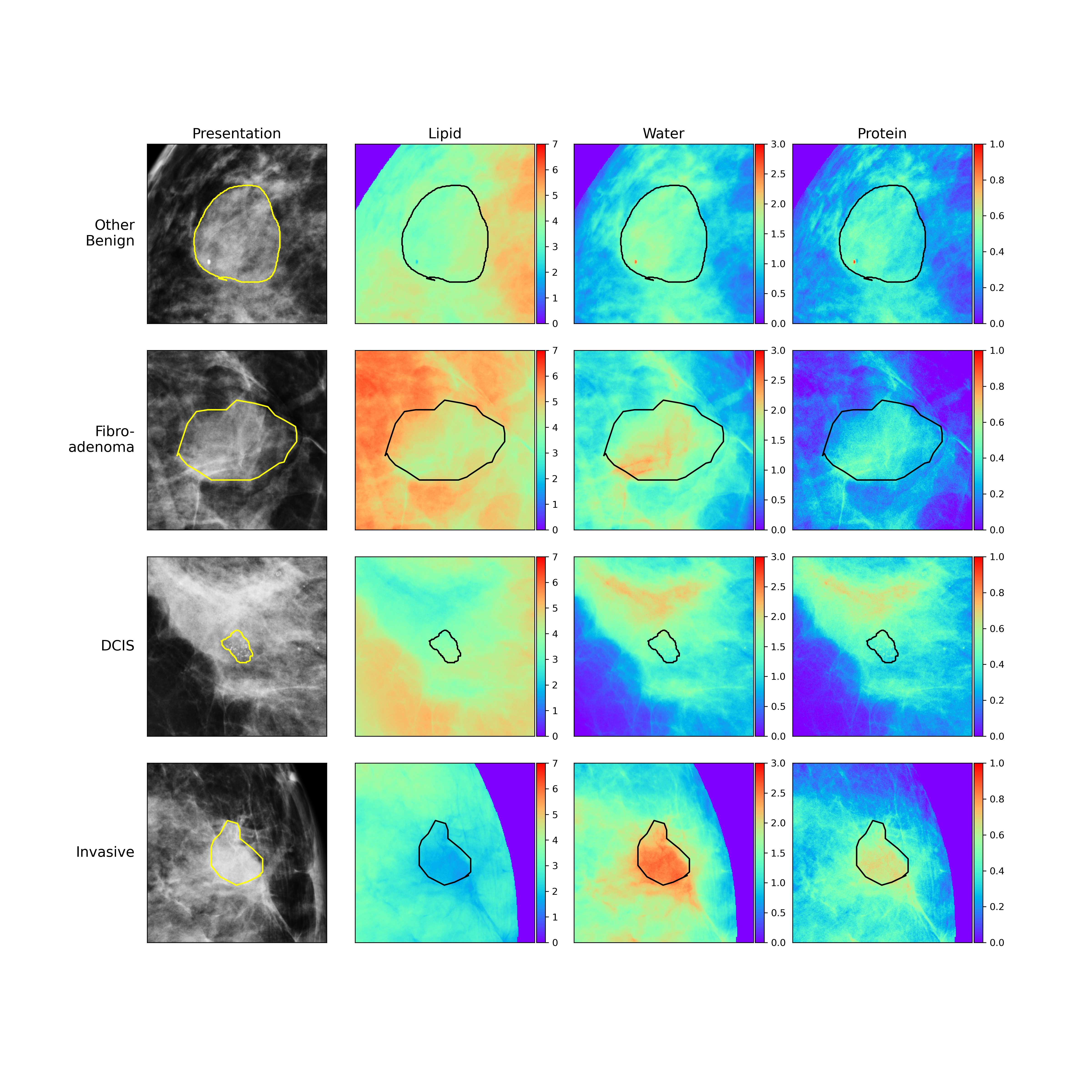 Compositional Imaging with Artificial Intelligence to Improve Breast Cancer Detection