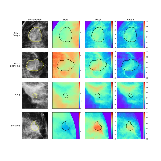 Compositional Imaging with Artificial Intelligence to Improve Breast Cancer Detection