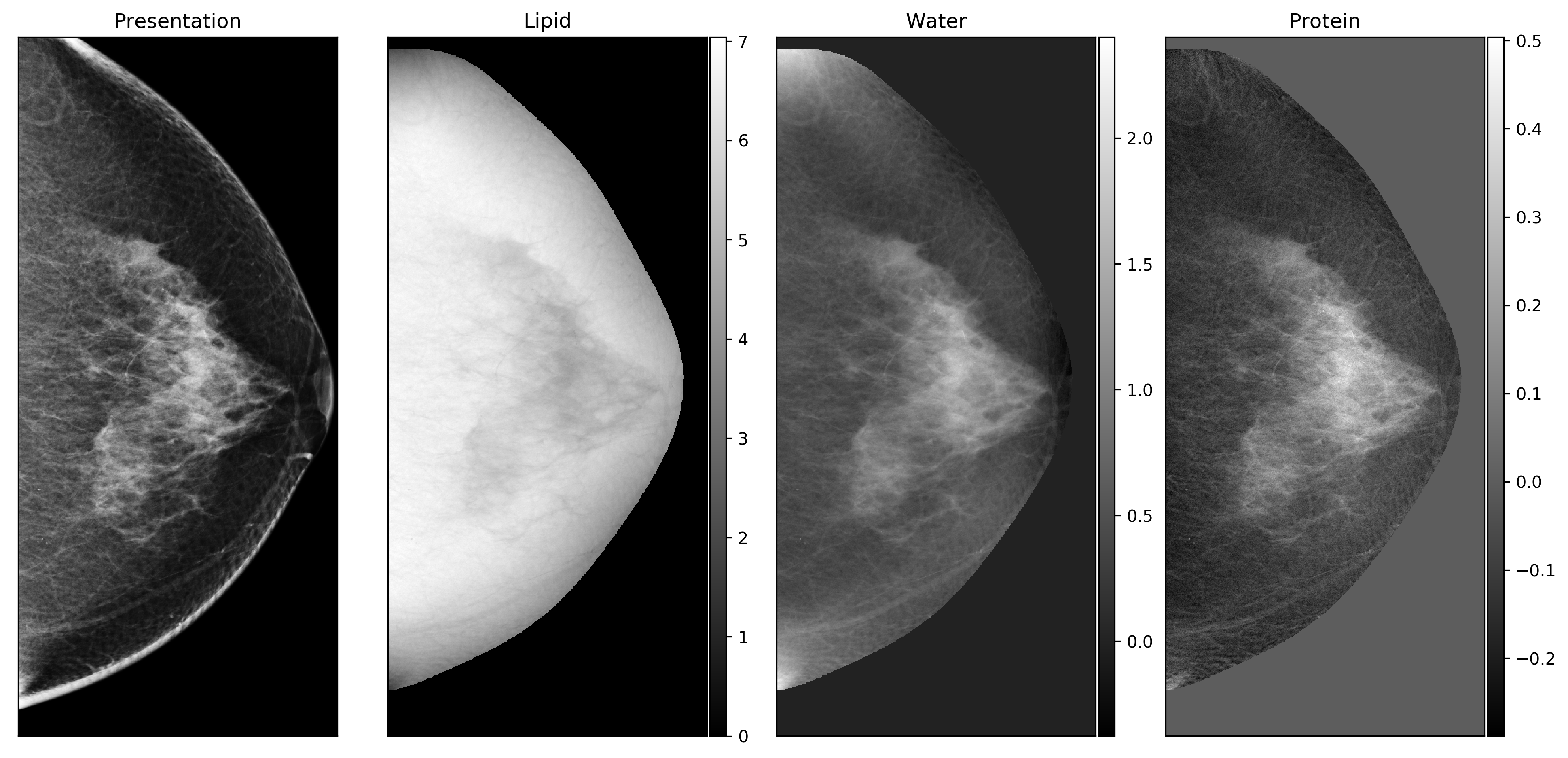 three compartment breast (3cb)_