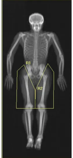 Example of secondary analysis with user defined subregions of the leg labeled R1 and R2.
