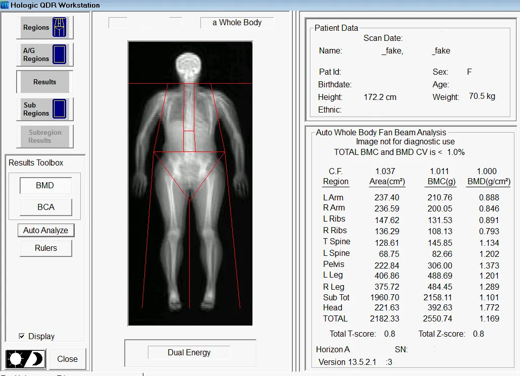 Screenshot of a Hologic QDR Workstation displaying a whole body DXA scan with detailed analysis of body regions, showcasing bone mineral density and body composition metrics.