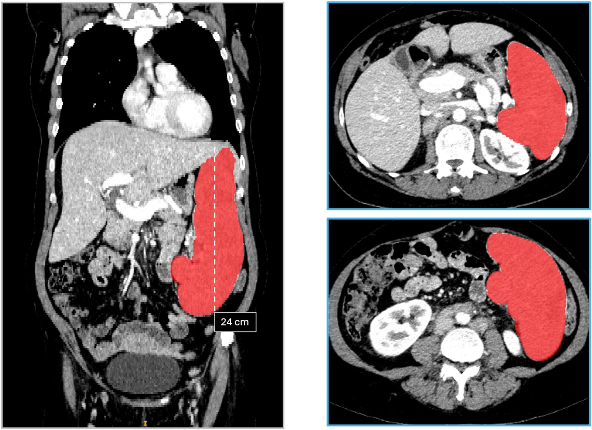CT segmentation figure showing spleen segmentation and measurement views.